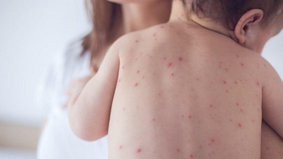 Chickenpox