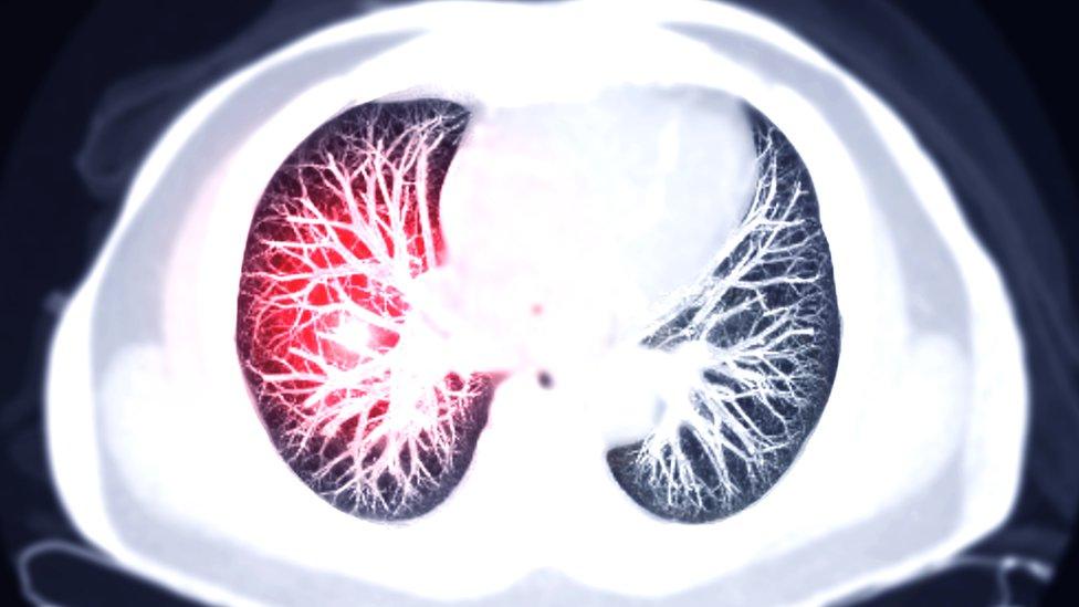 Scan of the lungs showing a pulmonary embolism