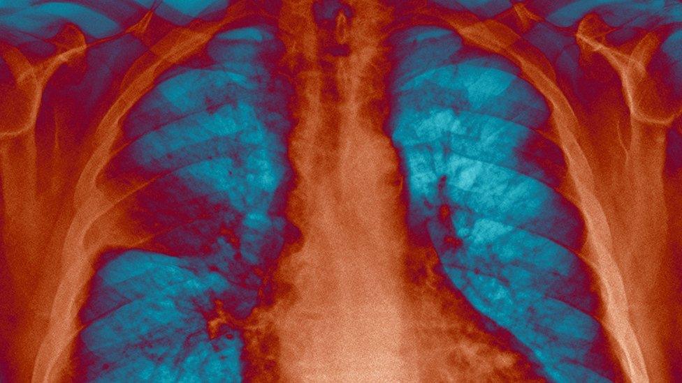 pneumococcal chest infection