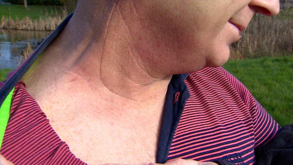 Martin's neck scar