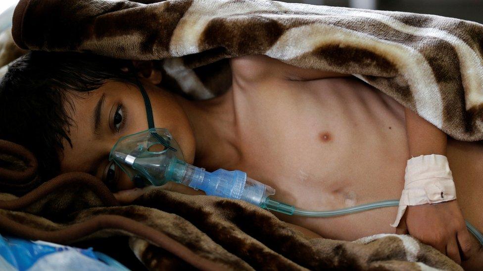 A boy in hospital in Sanaa, Yemen