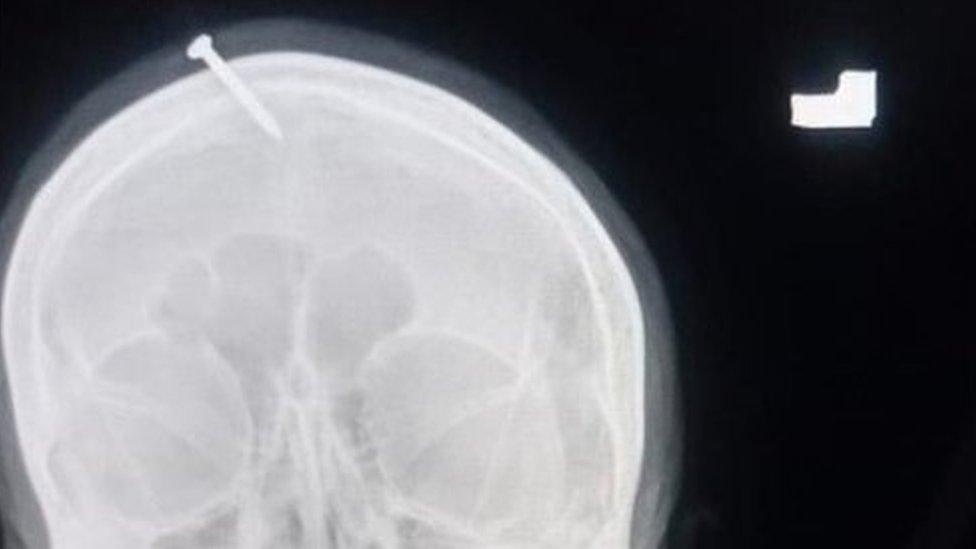 An x-ray of the nail stuck through the woman's head