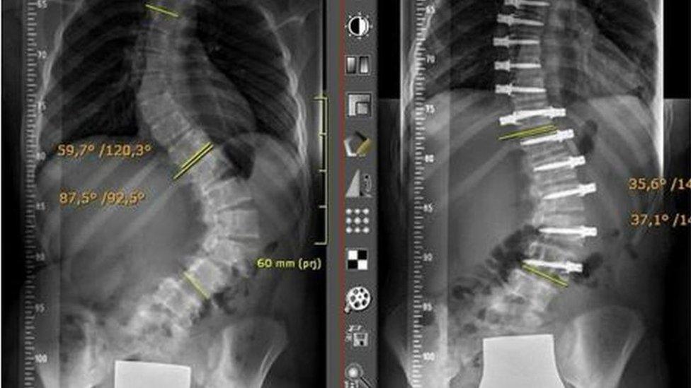 X ray before and after