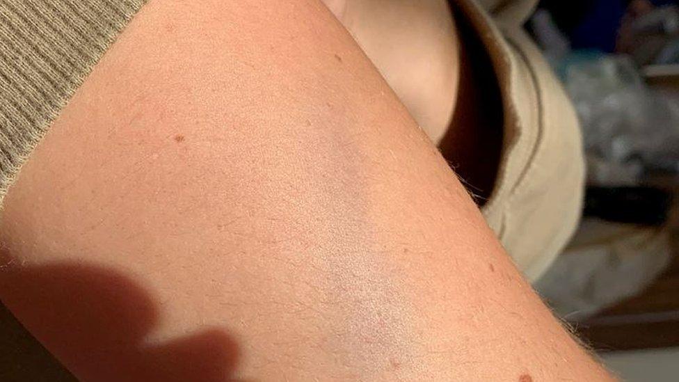 Bruise on Amy Taylor's arm