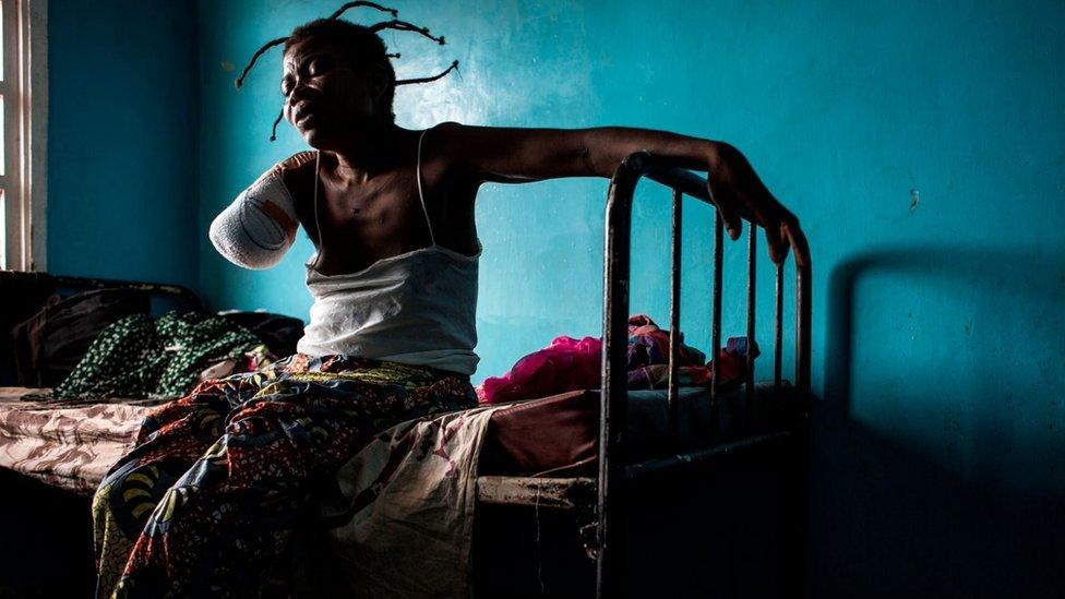 A Congolese women, who has had her arm amputated after a gun shot wound, sits on her bed on October 23, 2017 in Tshikapa