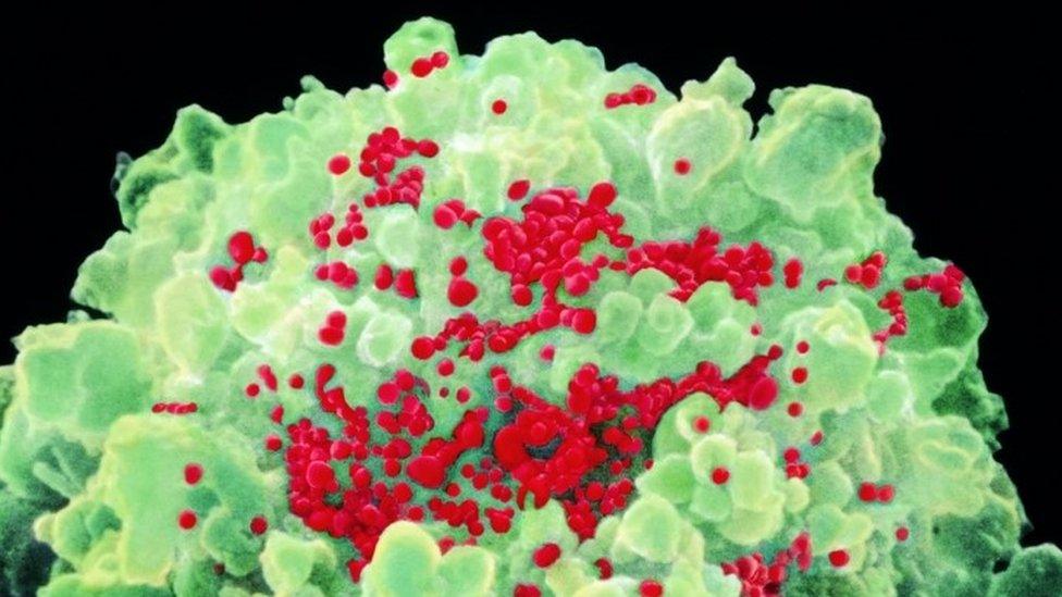 Electron micrograph of Aids