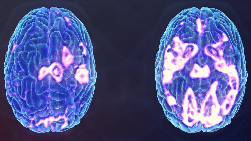 A depressed brain (l) and another after TMS stimulation