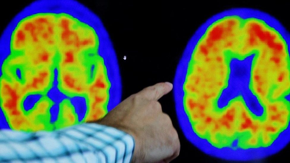 A doctor points out evidence of Alzheimer's disease on PET scans