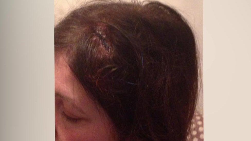 Injury suffered by Jo Brandon