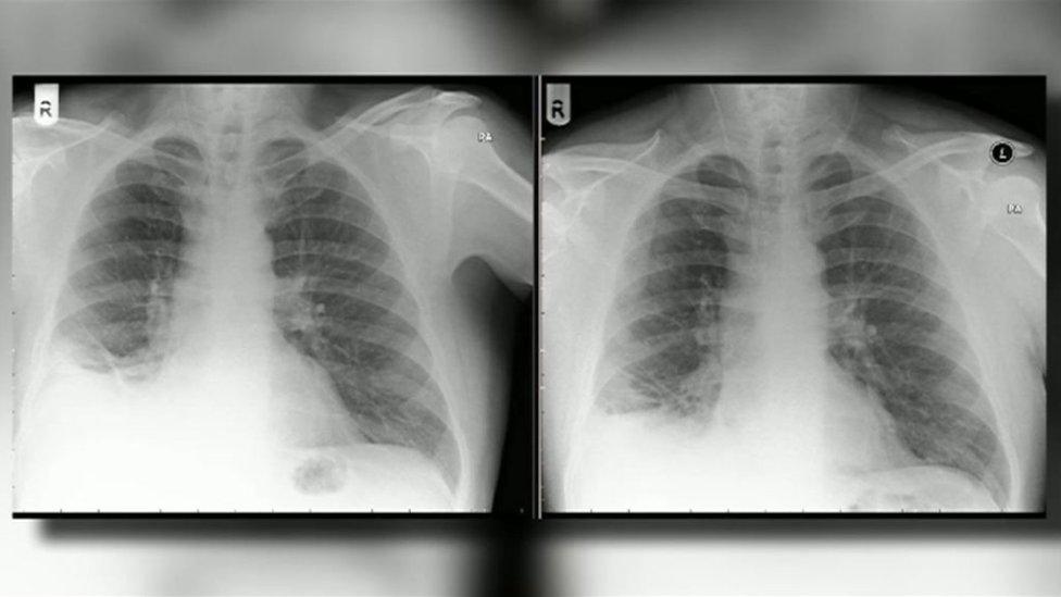 An X-ray of lungs