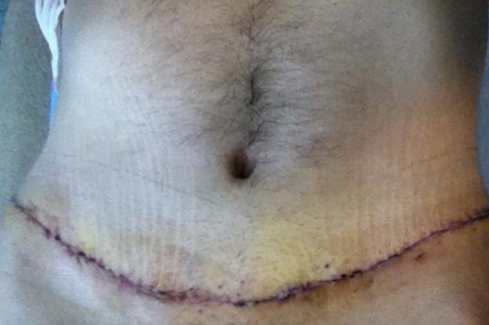 James Brumpton's abdomen