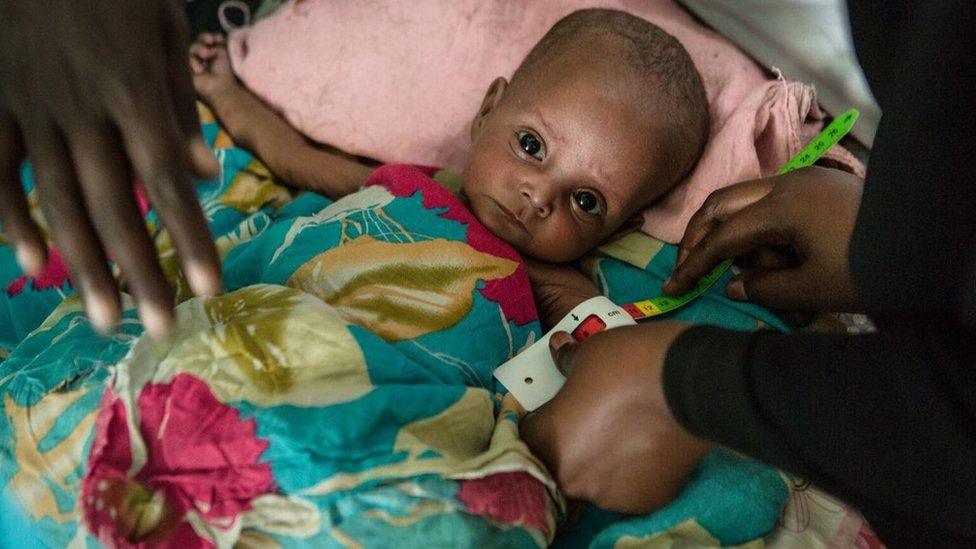 A six month old baby in Somalia