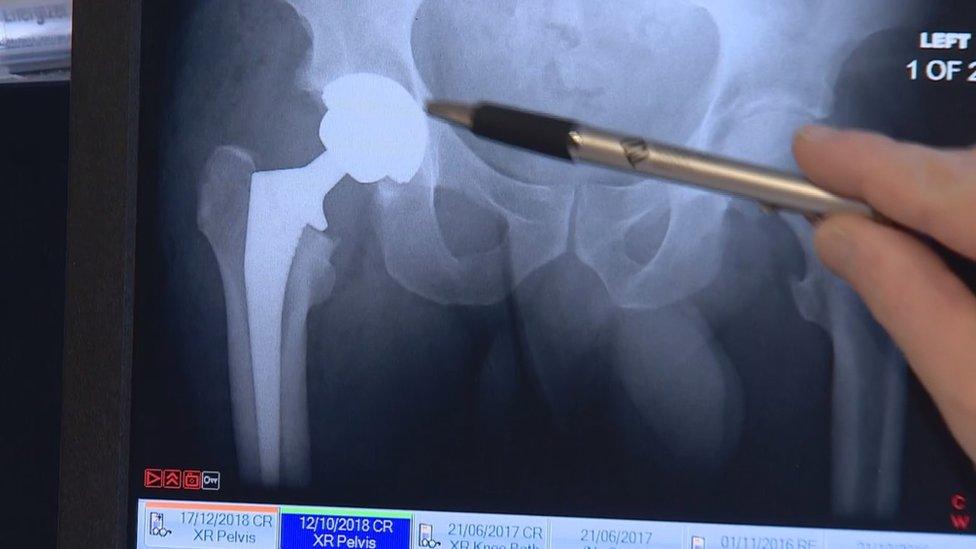 Hip bone x-ray