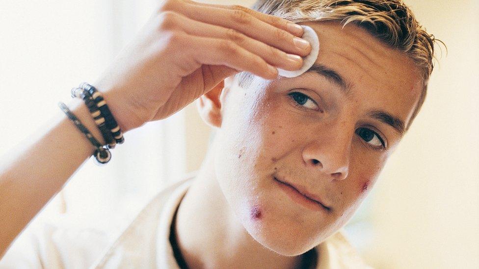 Teenager with acne