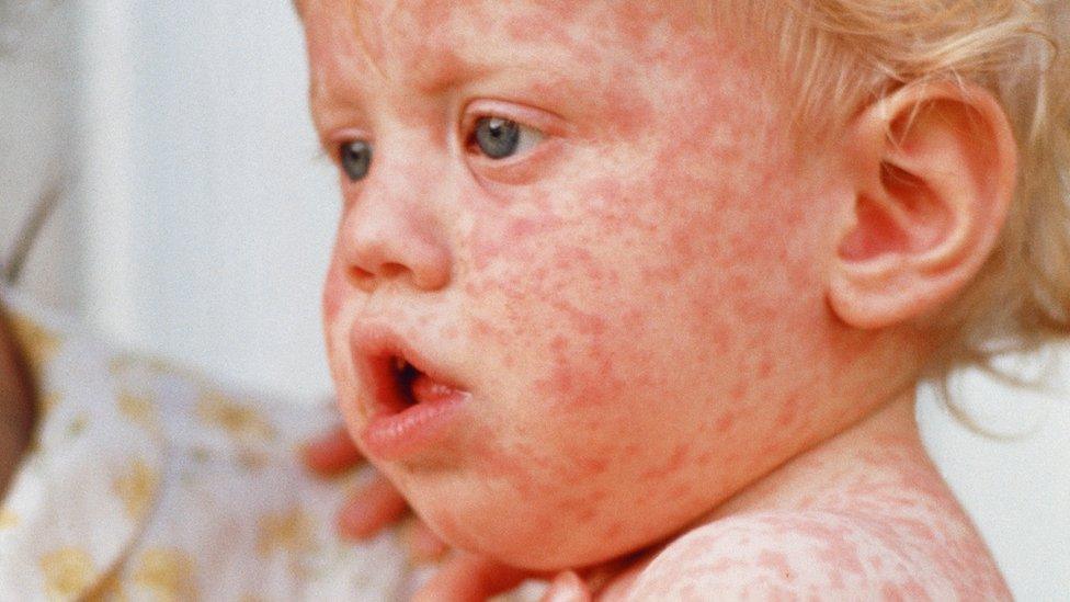 Measles rash