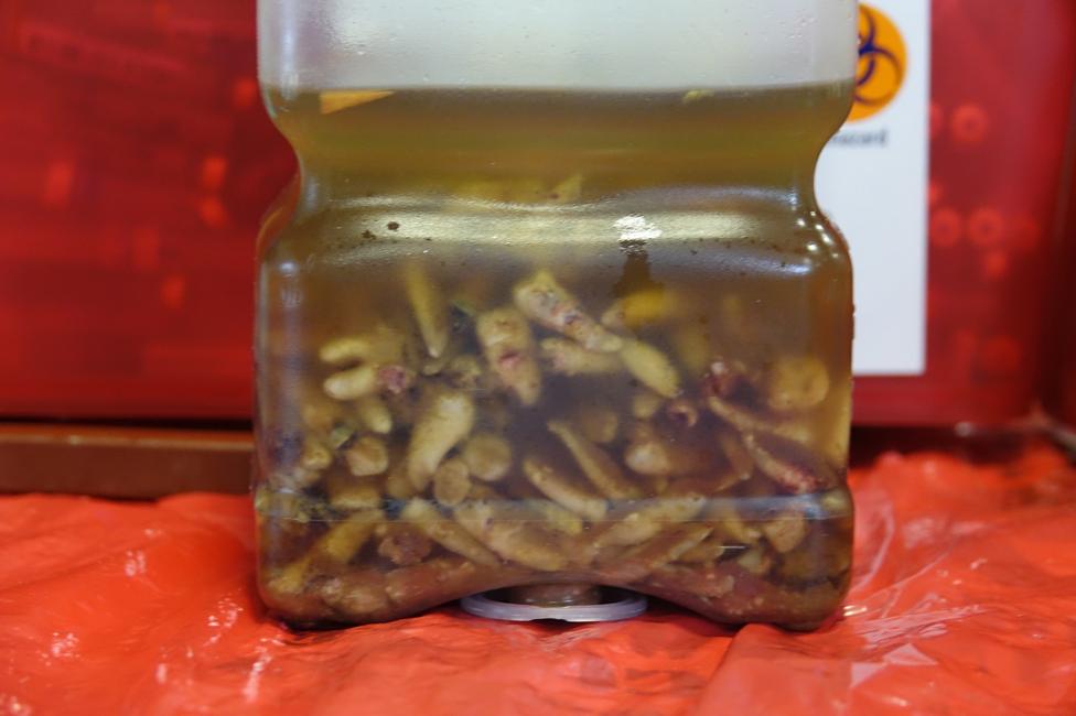 A jar of teeth extracted by RAM in Virginia