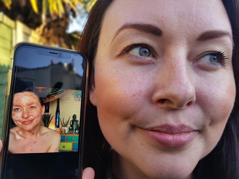 Aimee shows a picture of her psoriasis