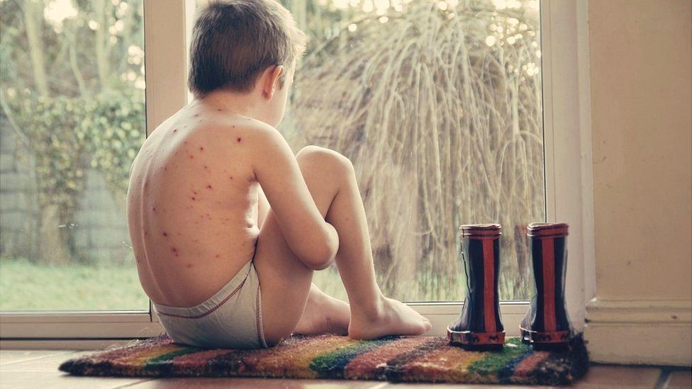 Boy with chickenpox