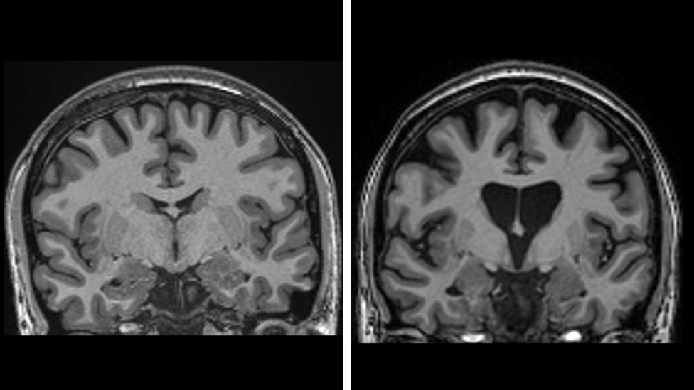The images show two cross sections of the human brain in black and white side- by-side. You can see the semi-circular outline of the skull. Inside is the folded brain matter. The key difference between the two images is the greater amount of dark space on the right demonstrating where brain tissue has died.