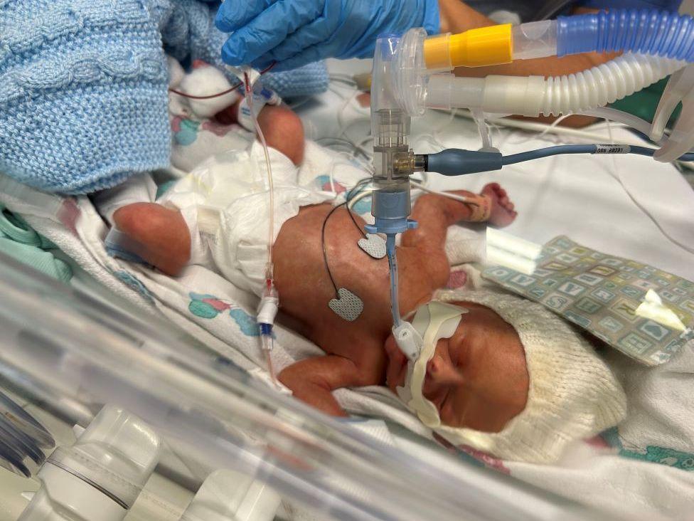 Kobi in an incubator when he was younger. He is wearing a nappy and a white hat. He has tubes all around him including one taped to his mouth.