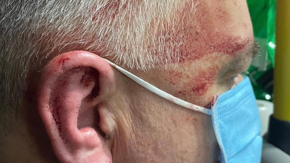 A side view of a man's face which is cut. He has grey hair and is wearing a blue medical face mask. His ear is also cut with dried blood on it.