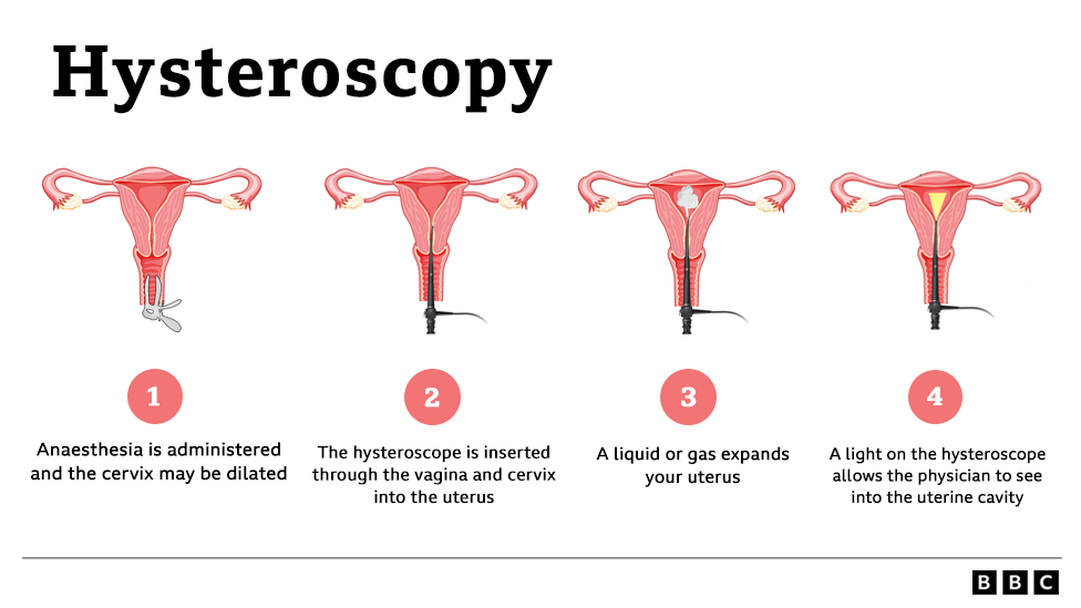 Graphic describing the hysteroscopy process