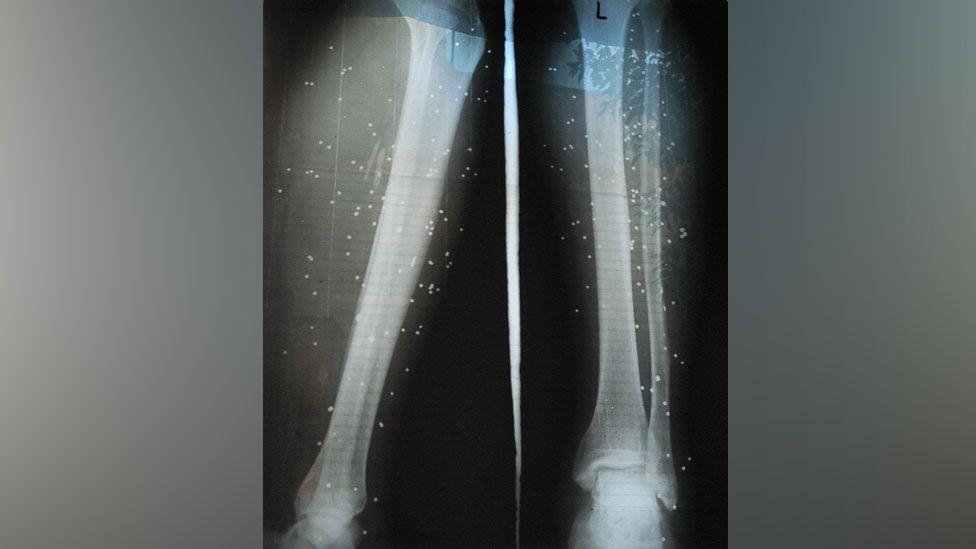 An X-ray showing birdshot in the legs of a wounded protester in Iran