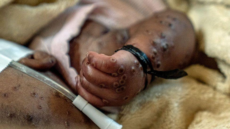 The arm of a baby with mpox blisters in Lwiro hospital, DR Congo