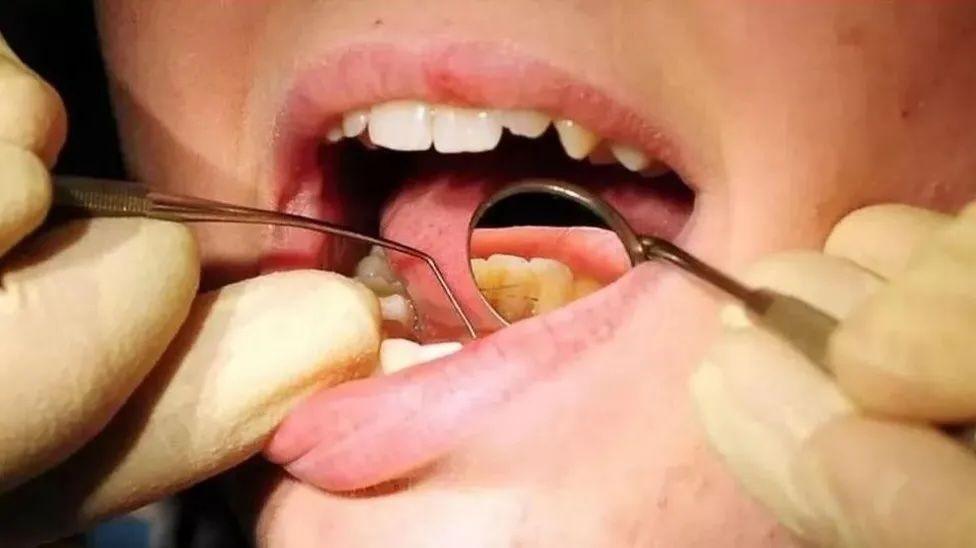 A close-up of a child's mouth open, with gloved hands holding dentist utensils in it.