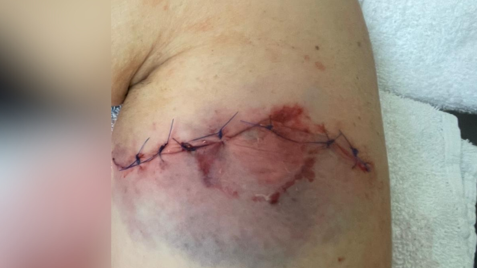 A woman's arm with a large red wound which has been stitched up. The skin is red and purple and the stitching is blue.