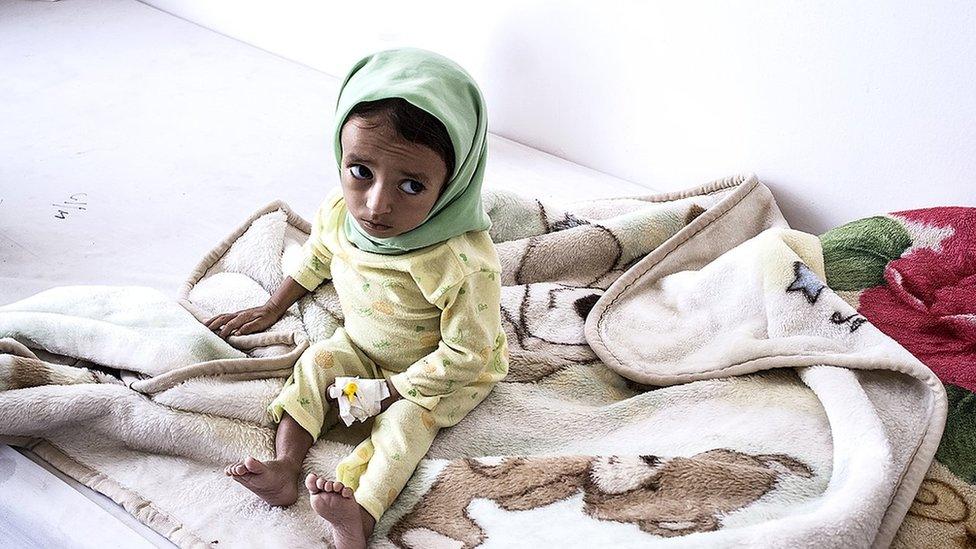 Malnourished child at Sanaa’s al-Sabeen Hospital