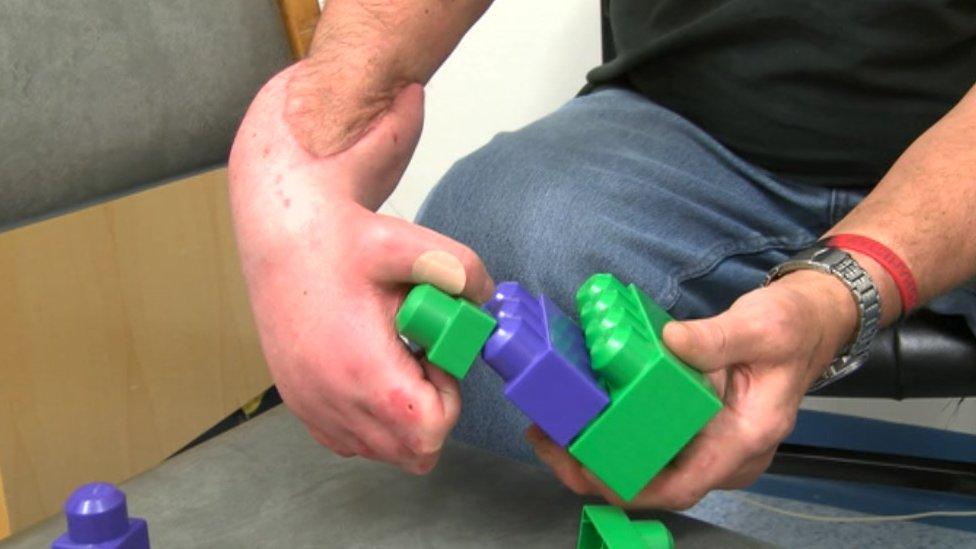 Mark Cahill putting plastic blocks together with his new hand