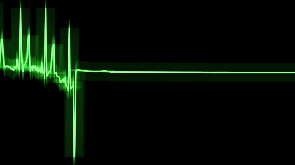 ECG (electrocardiogram) trace