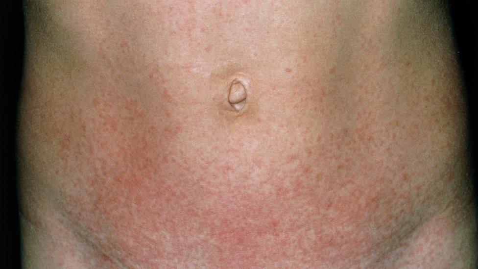 Scarlet fever rash