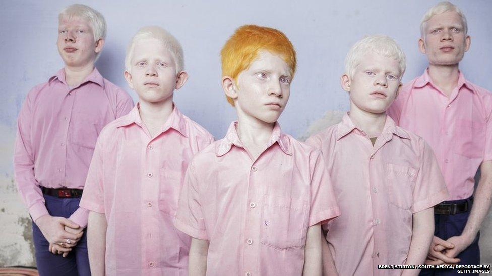 A group of blind boys suffering from albinism photographed in their boarding room at the Vivekananda mission school for the blind in West Bengal, India