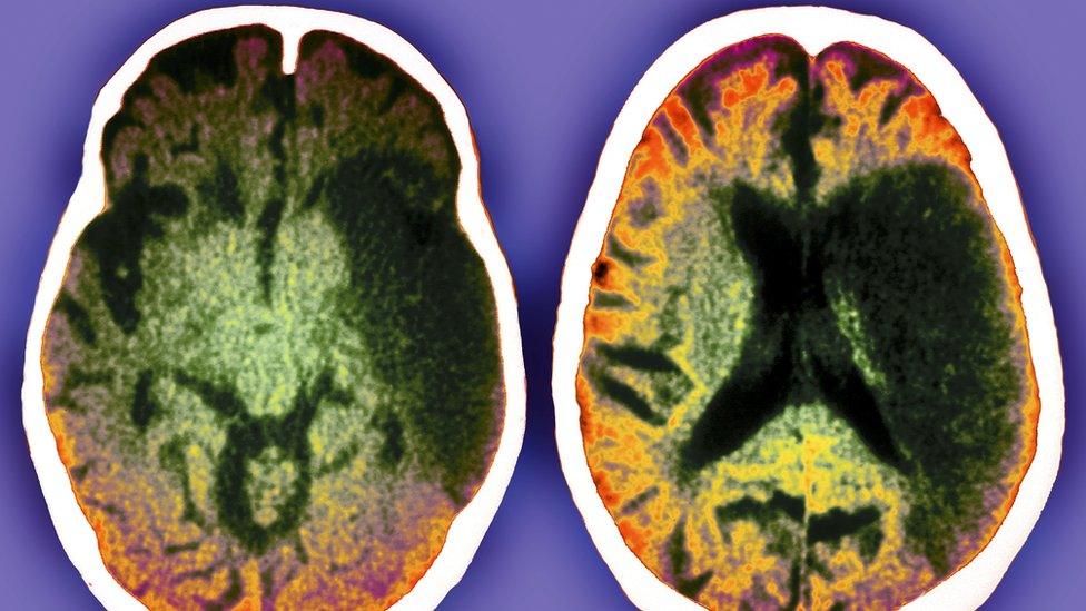 CT scans of a stroke patient's brain