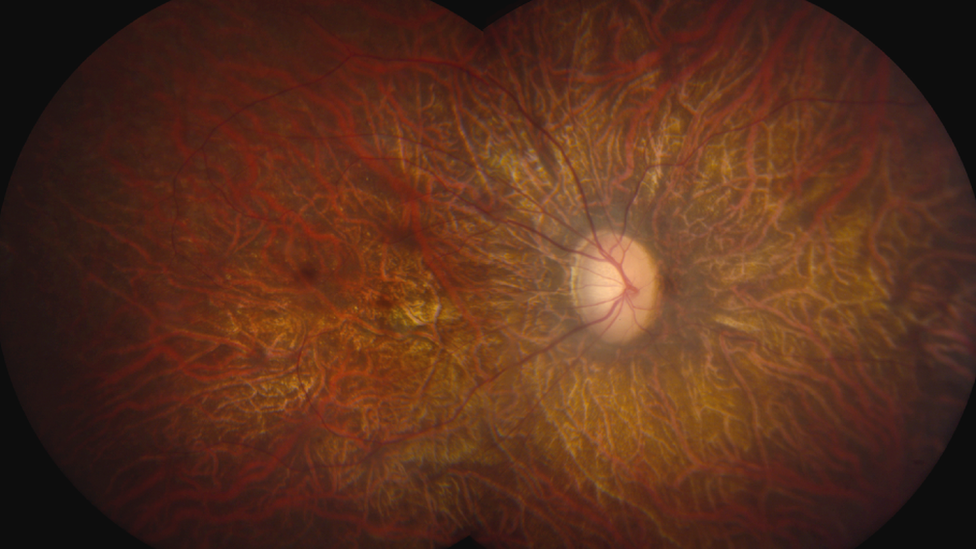 LCA affects the functioning of the retina, the light-sensitive tissue at the back of the eye