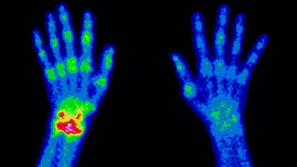 Hands x-rayed