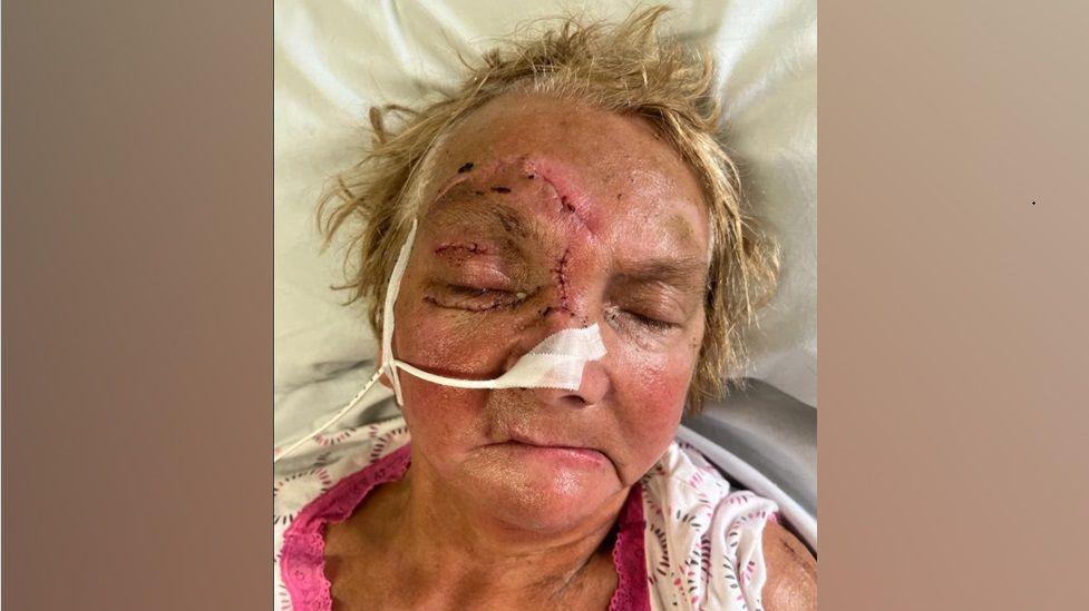 Margaret Scaldwell is lying in her hospital bed. She has a number of scars and stitches on her face and she has a medical wire attached to her nose.
