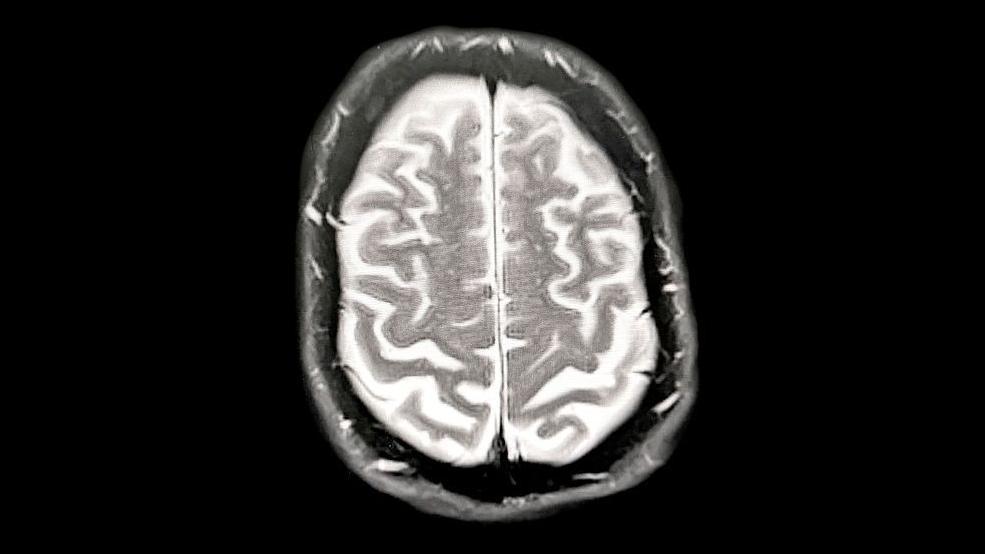 A MRI scan of a brain showing the early onset of dementia