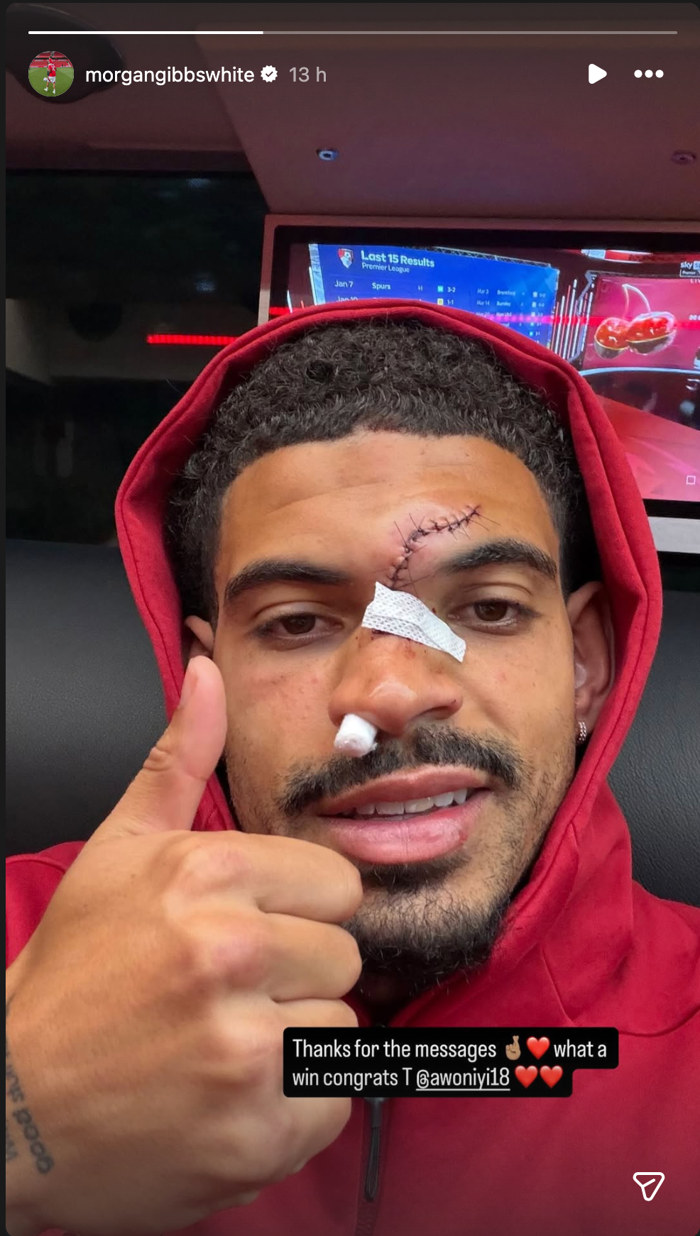 Morgan Gibbs-White's Instagram story showing stitches across his forehead and nose. He also has a cotton bud up one nostril to stem bleeding