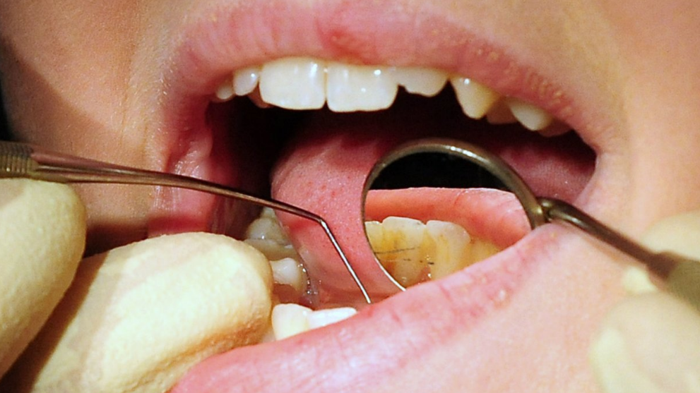 Close up of a dentist working on someone's mouth