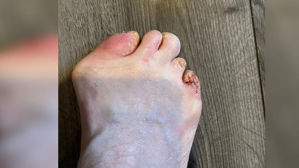 A foot that is missing the ends of some toes. 