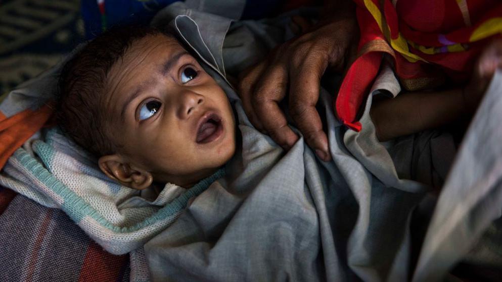 A malnourished child awaits treatment at a clinic in the Fakir Bagan slum area of Kolkata. The clinic is run by the charity Calcutta Kids. Founded in 2004, Calcutta Kids is a not-for-profit public health organization committed to the health and empowerment of the underserved women and young children in the Kolkata slum area of Fakir Bagan