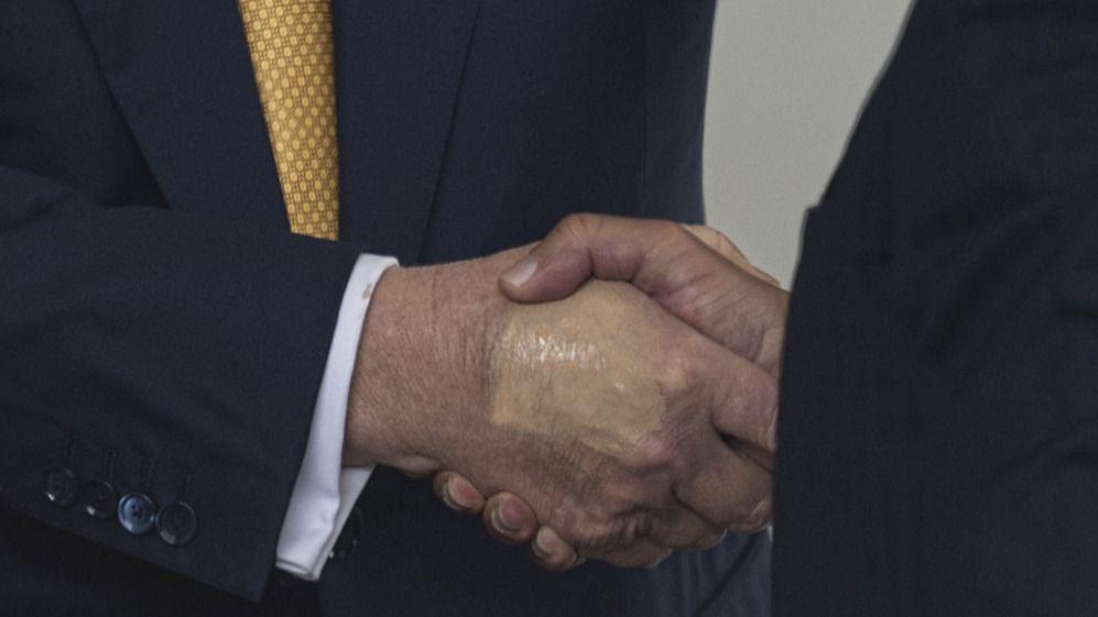 Bruising is seen on President Donald Trump's hand while shaking the hand of Crown Prince and Prime Minister of the Kingdom of Bahrain Salman bin Hamad bin Isa Al Khalifa at the White House 16 July, 2025.