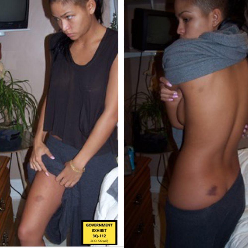 A split image, on the left a woman lifts her skirt to show a bruise on her right leg. On the right that same woman lifts her shirt to show a bruise on her lower and upper back.