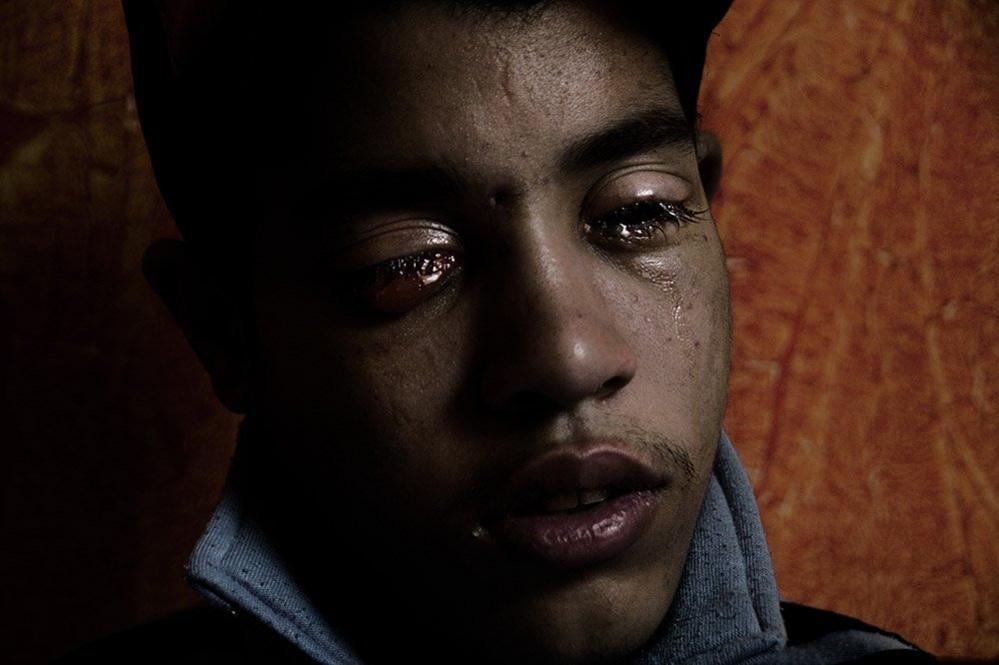 A boy with injured eye