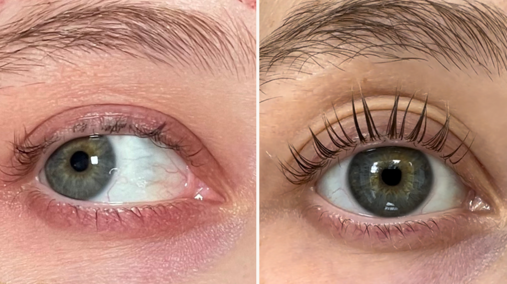 Isobel's eye look very sore and red (left) compared to how they look now, which is clear and now redness around the eyes (right)