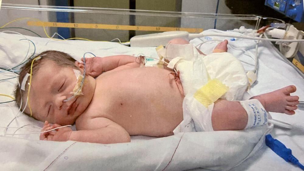 A new born baby is lying in a hospital cot, wearing a white diaper and a hospital identification band on one ankle. The baby is connected to several medical wires and tubes, which are attached to monitoring equipment. The setting appears to be a neonatal care unit, with a white sheet beneath the baby and medical devices visible in the background.