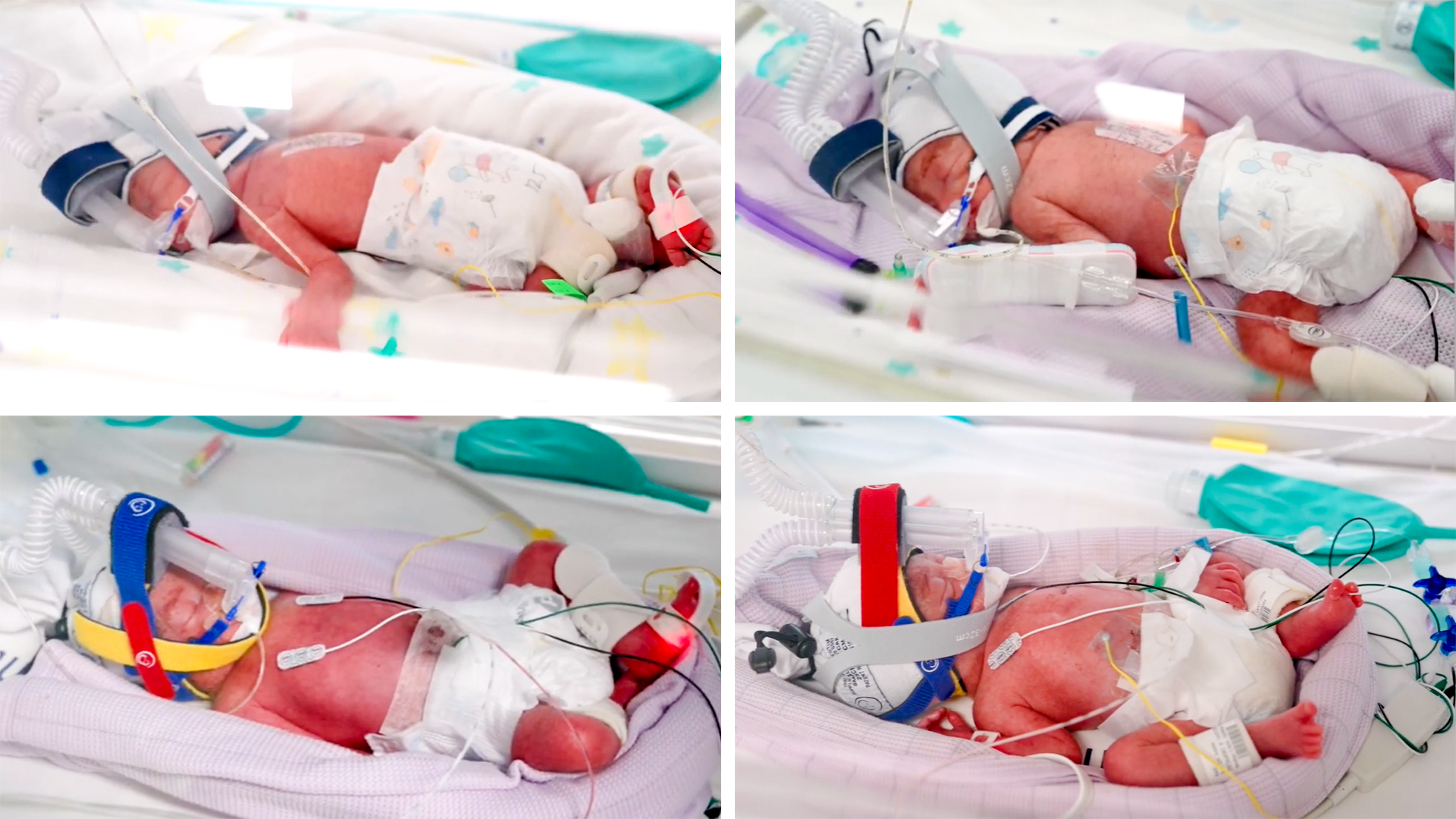 Los bebés cuatrillizos que aparecen en una imagen compuesta se encuentran en la sala de neonatos del hospital, en una incubadora, con un respirador artificial y varios cables conectados.